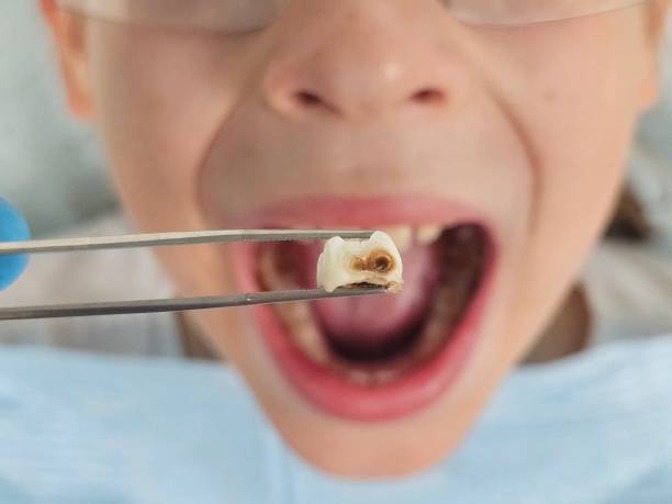Best Emergency Broken Tooth Repair in Sunnyslope, WA